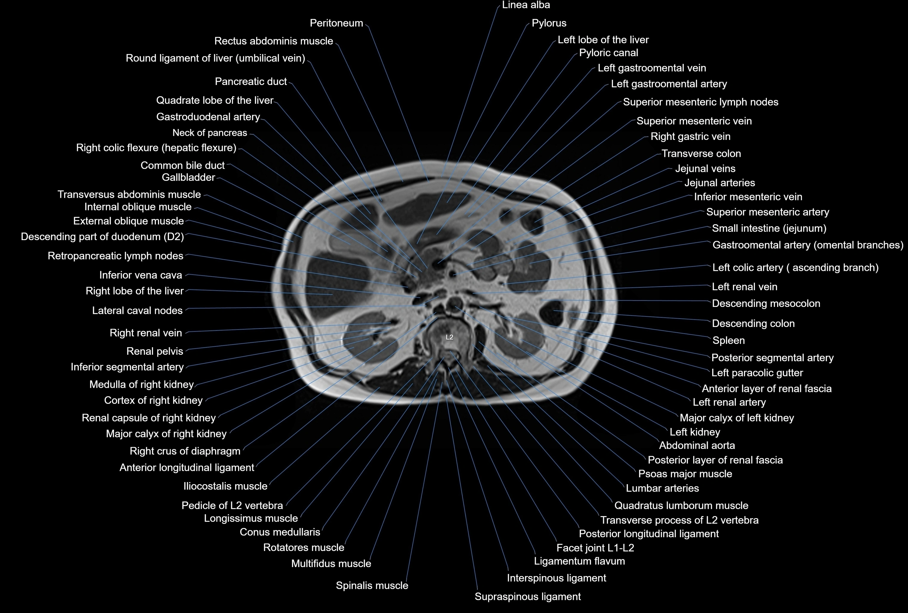 MRI Abdomen axial cross sectional anatomy radiology  image-img-00001-00020.webp